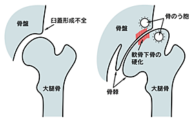 形成 股関節 臼 不全 蓋 臼蓋形成不全の原因と治し方