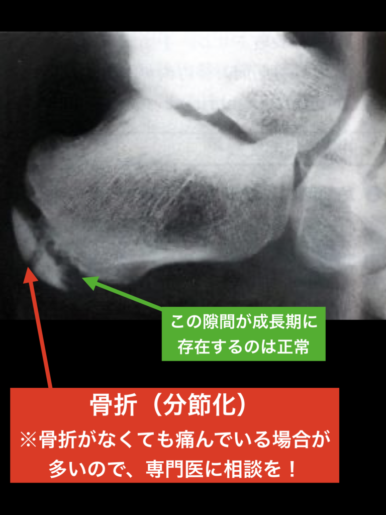 踵骨骨端症 シーバー病 セーバー病 宇都宮のはせがわ整形外科