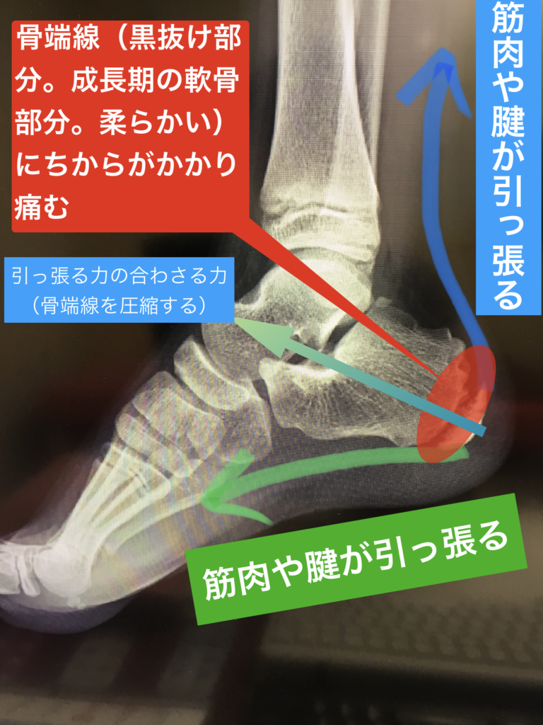 踵骨骨端症 シーバー病 セーバー病 宇都宮のはせがわ整形外科