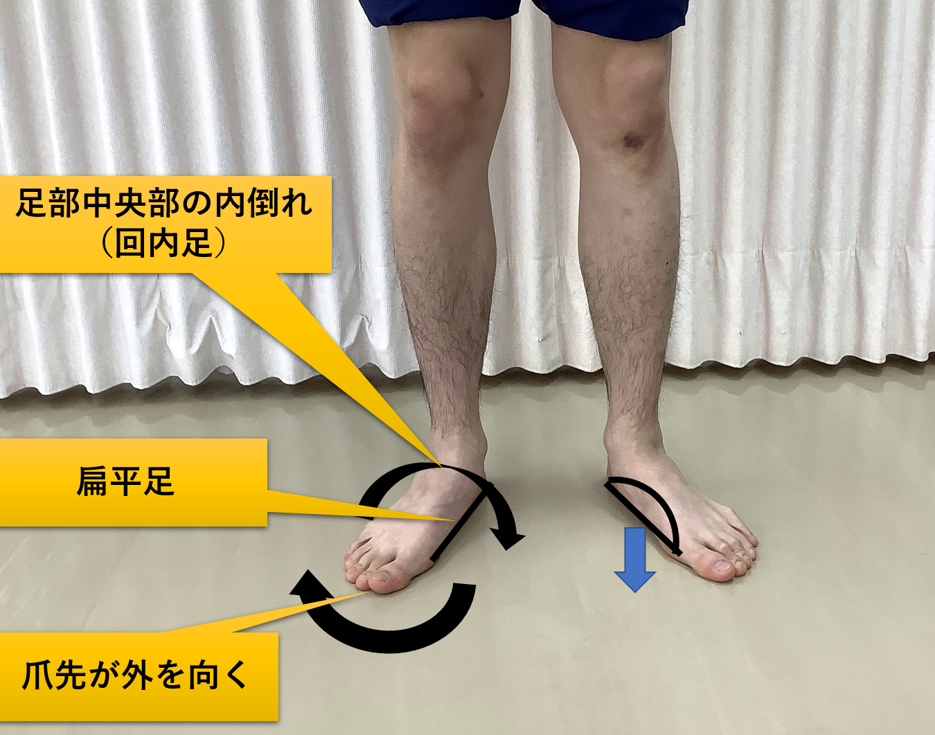 外側 足 の 痛い 裏 足の裏の正しい名称－足の裏全体や部分の名称を図で解説