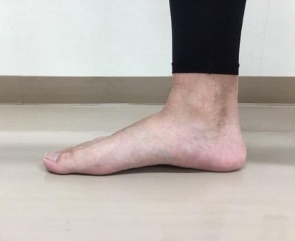 足底筋膜炎 足底腱膜炎 宇都宮のはせがわ整形外科