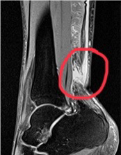 アキレス腱損傷のMRI画像