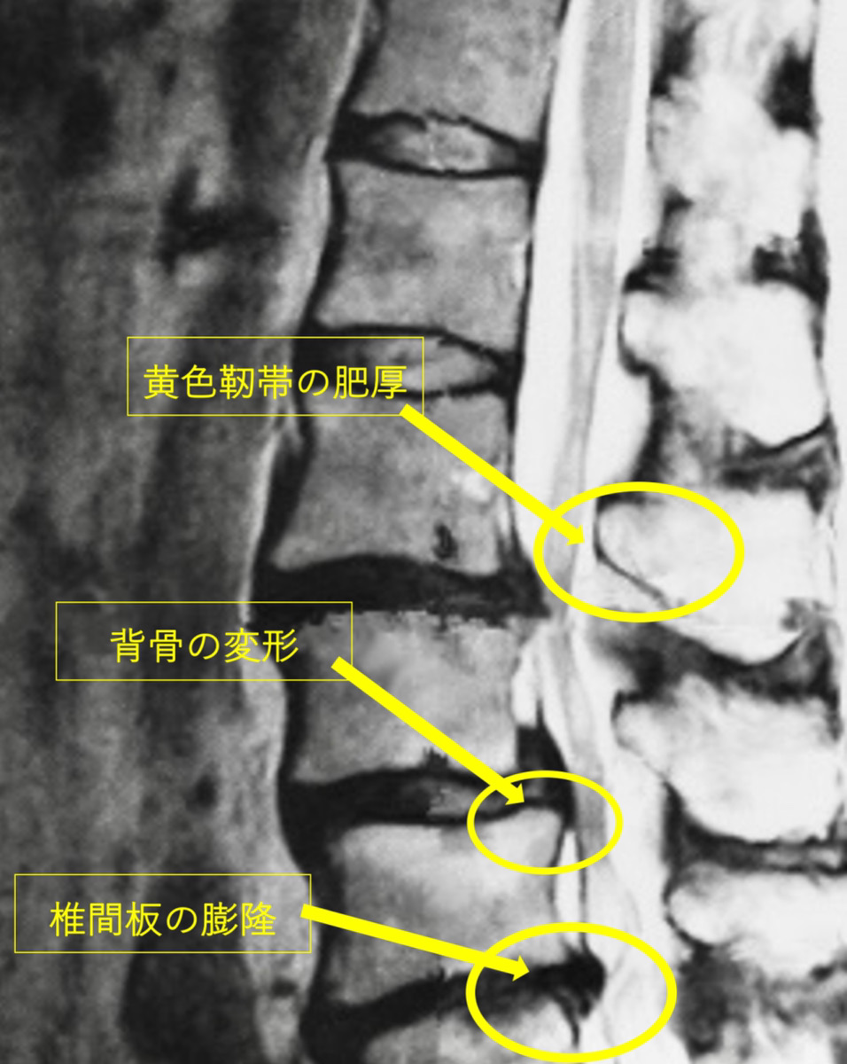 脊柱管狭窄症 腰部脊柱管狭窄症 宇都宮のはせがわ整形外科