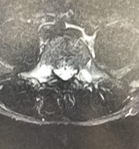 図３：腰椎分離症MRI　初期