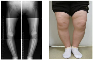 変形性膝関節症でよくある見た目とレントゲン写真